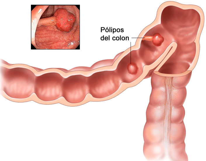tratamiento quirúrgico cáncer de colon