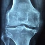 Artrosis y su tratamiento con la quiropráctica