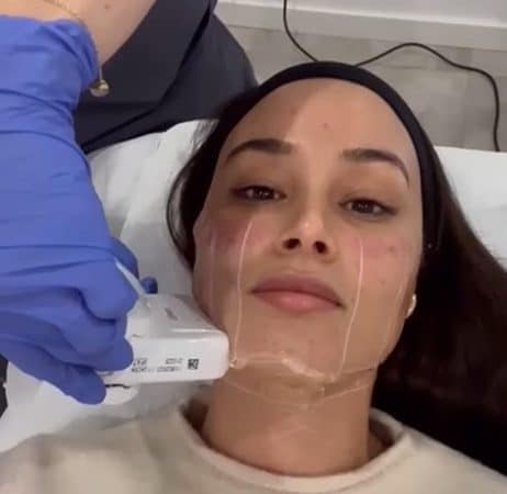 HIFU Facial, estética antienvejecimiento no invasiva