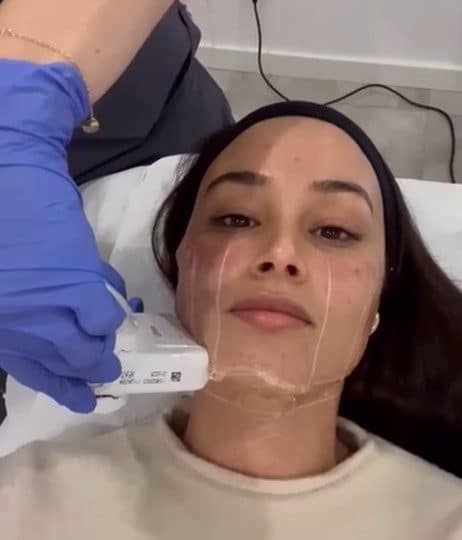 HIFU Facial, estética antienvejecimiento no invasiva