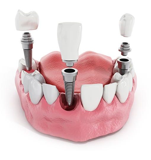 Implantes dentales de última generación