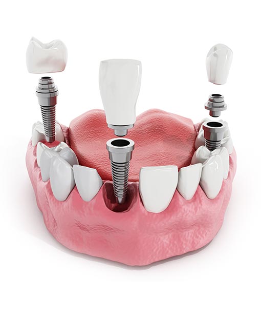 Implantes dentales de última generación