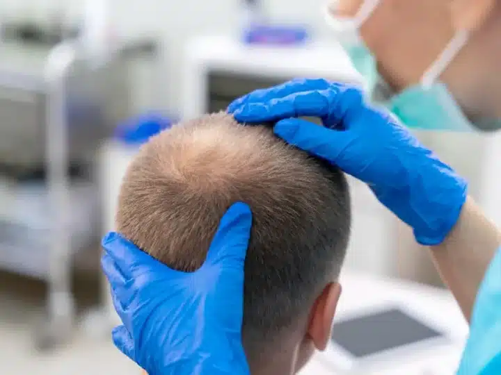 Injerto o tratamiento médico capilar: cómo elegir la mejor opción para frenar la caída y recuperar densidad