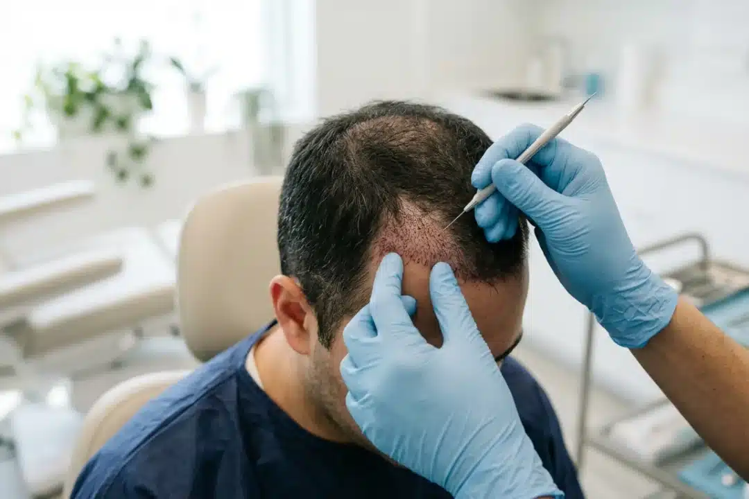 Injerto capilar en Valencia: la solución definitiva para recuperar el pelo